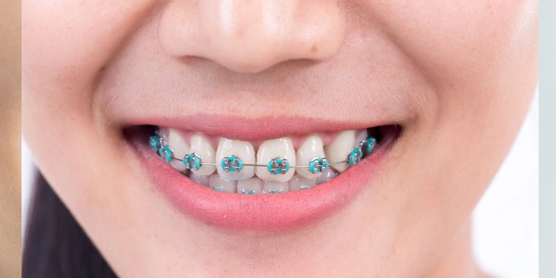 Quiz How Long Will I Need Braces? BestFunQuiz