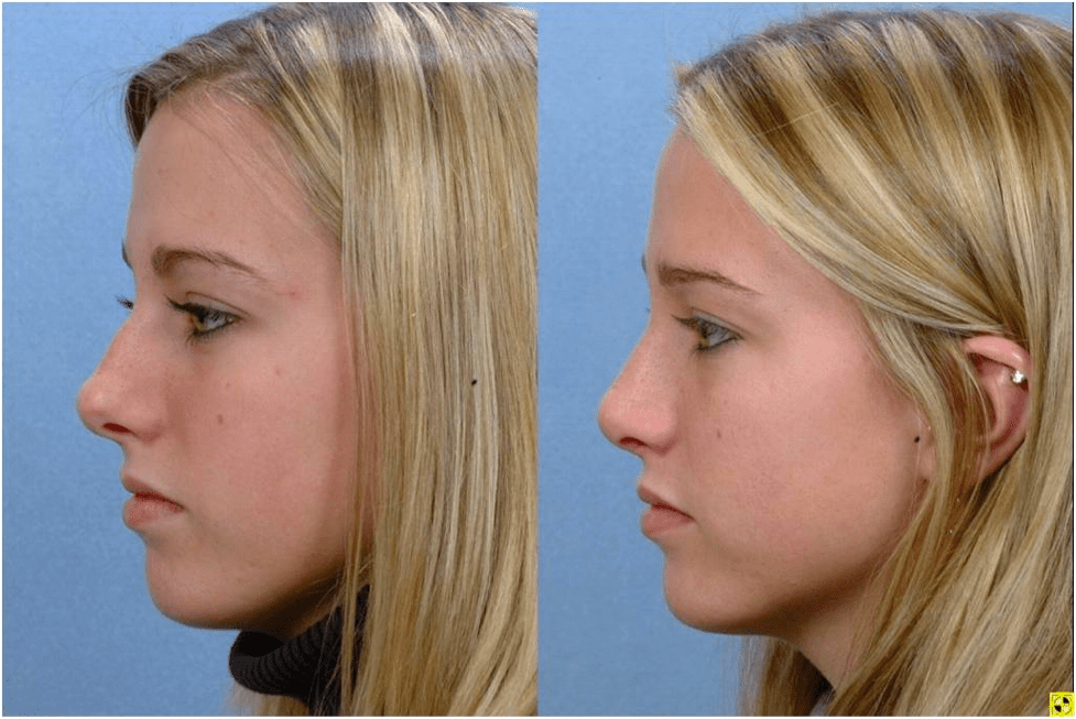 What to Expect After the Rhinoplasty