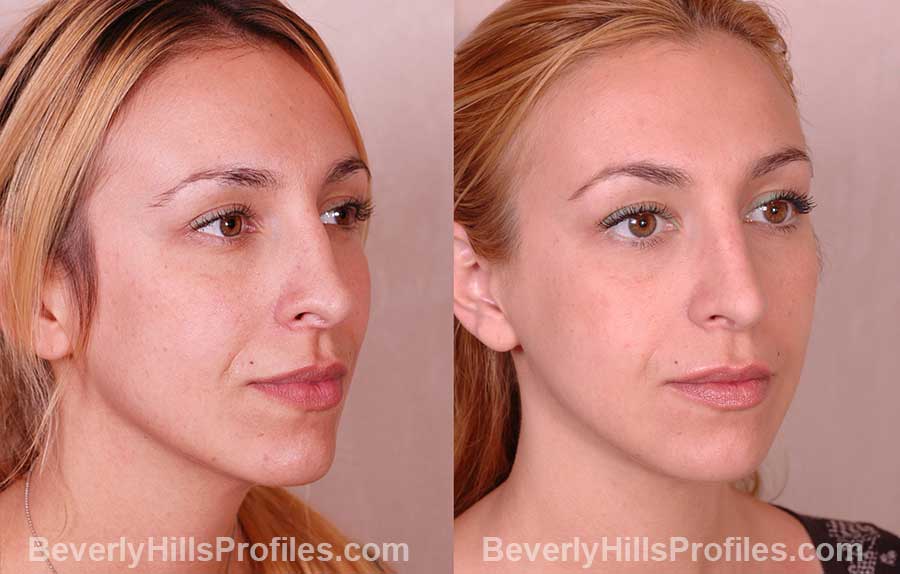 Rhinoplasty Before & After Photos, Beverly Hills LA Rhinoplasty