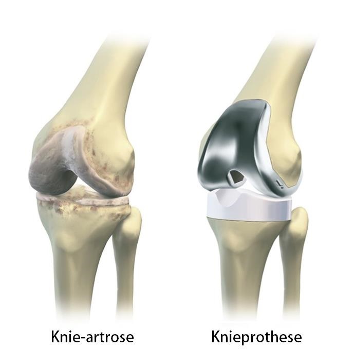 Knieprothese | Wat Is Het En Welke Soorten Zijn Er?