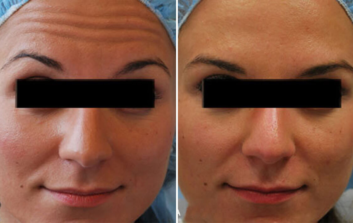 Botox Injections in NYC Botox Specialist New York