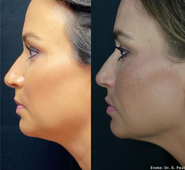 Evoke Facial Remodeling in NYC l Hellman Dermatology