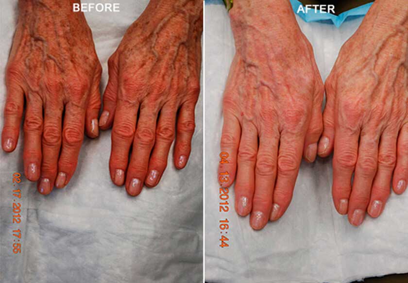 Fotofacial RF Treatment NYC Fotofacial New York