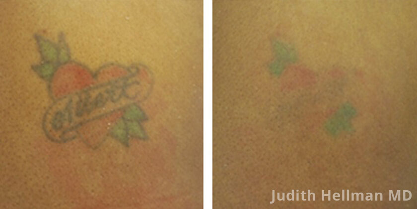 Tattoo Removal Before & After Photos NYC