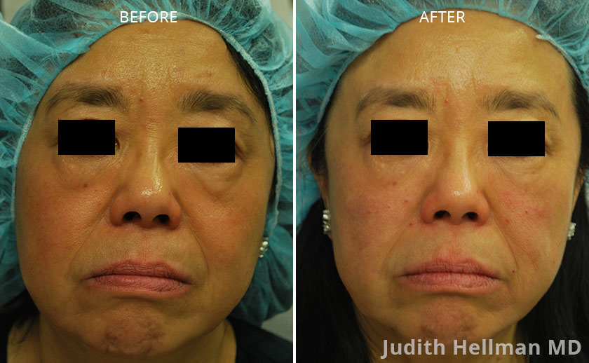 UNDER EYE BAGS & DARK CIRCLES BEFORE & AFTER PHOTOS