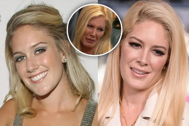 20 Disturbing Results of Plastic Surgery Gone Wrong