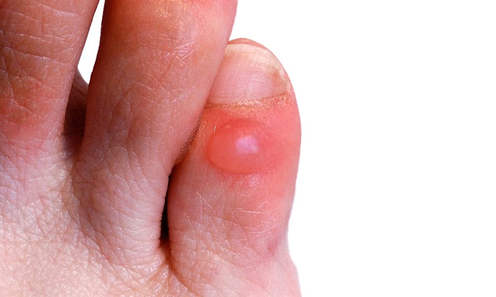 Treating blisters on the trek