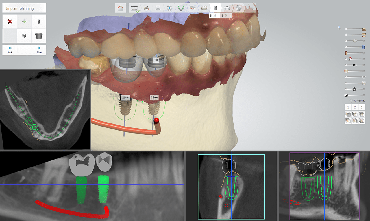 Guided Surgery Biodenta Your Total Solution Provider