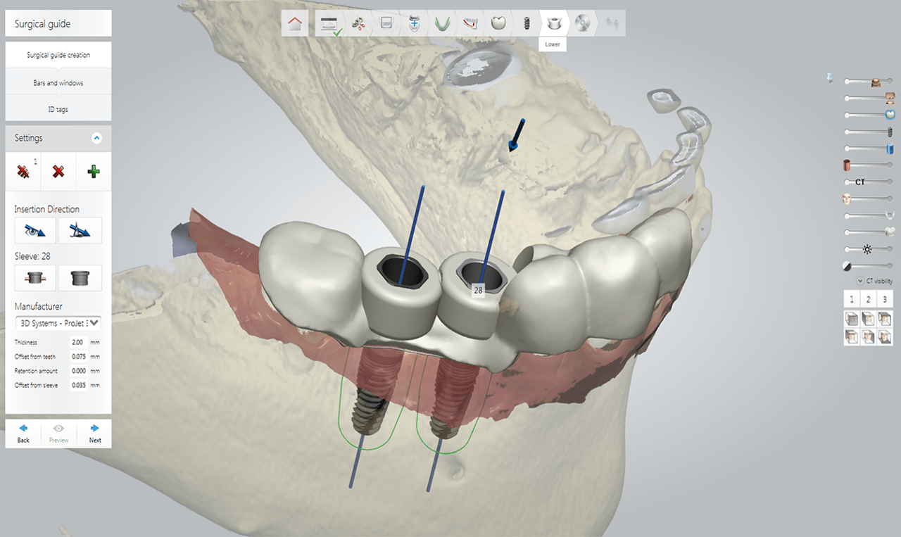 Guided Surgery Biodenta Your Total Solution Provider