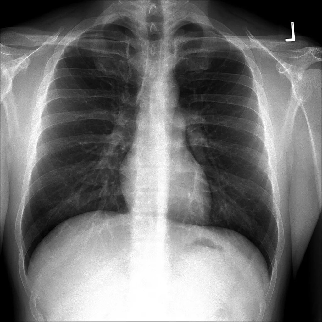 Free diagnosis and medicines for TB patients