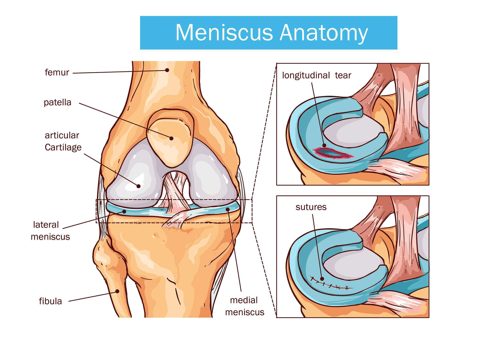 Can You Treat a Meniscus Tear Without Surgery? BioXcellerator