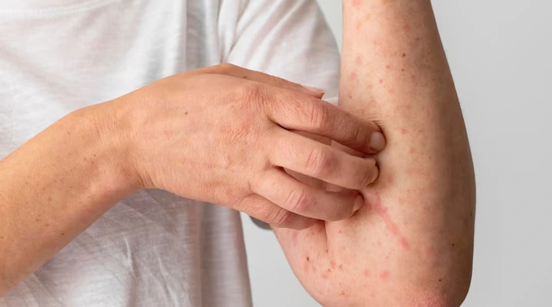 Symptoms and Causes of Shingles Sujata Birla Hospital