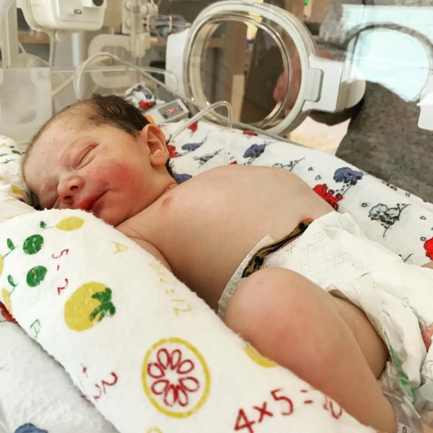 3c Tear and Infant Birth Injury Rebecca',s Story Birth Trauma