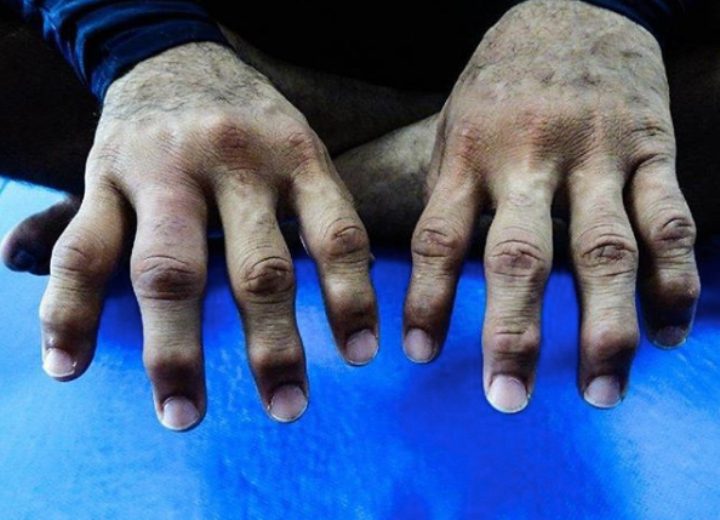 How To Decrease Knuckle, Finger & Joint Pain in JiuJitsu