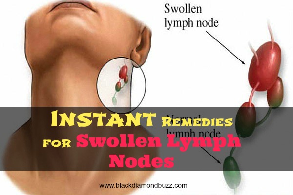 Instant Remedies for Swollen Lymph Nodes causes and symptoms