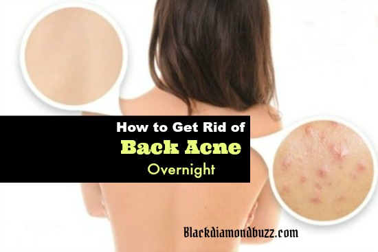 How to Get Rid of Back Acne Fast 7 Best Home Remedies for Backne