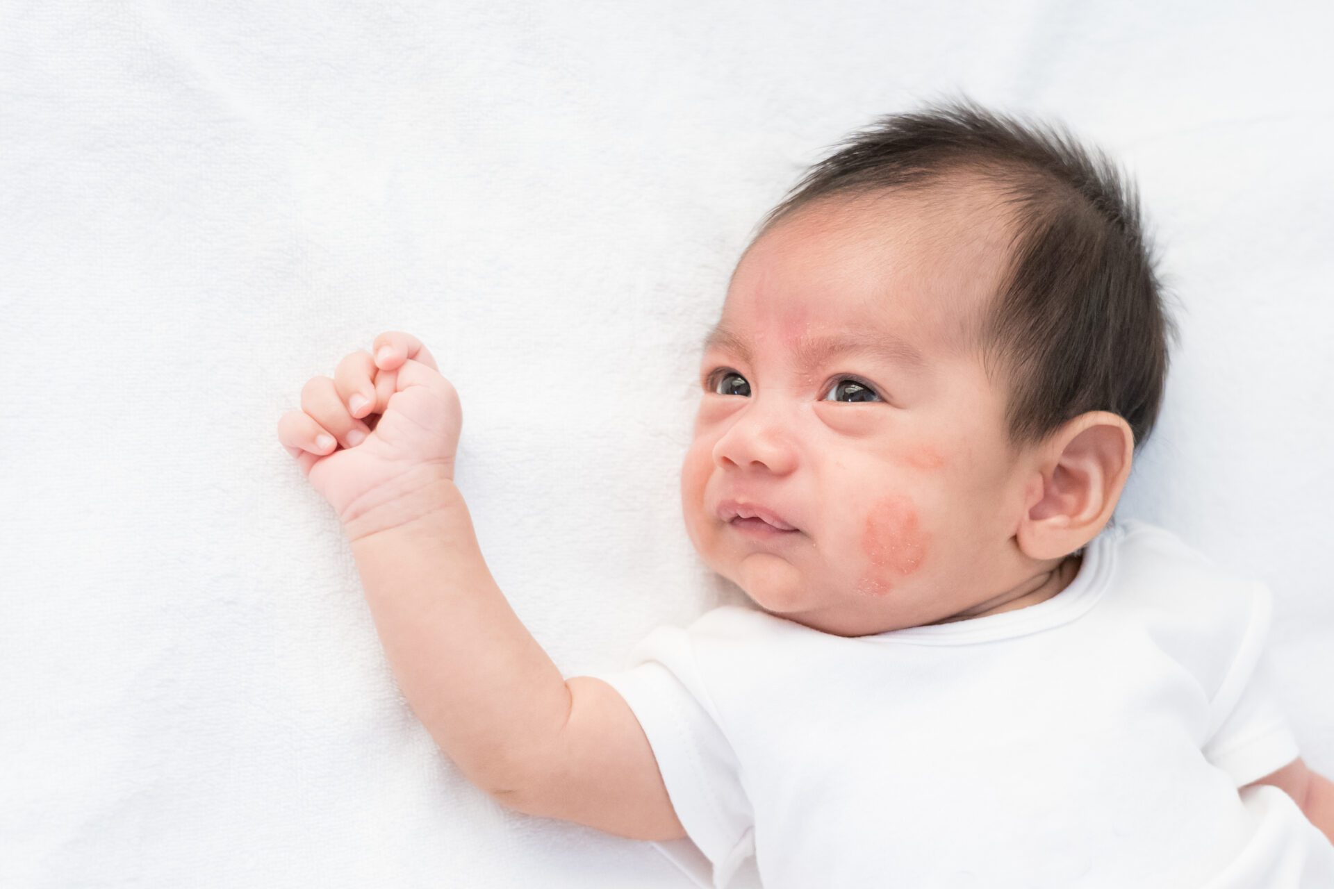 Identifying and Treating Baby Rash on Face BLDG Active