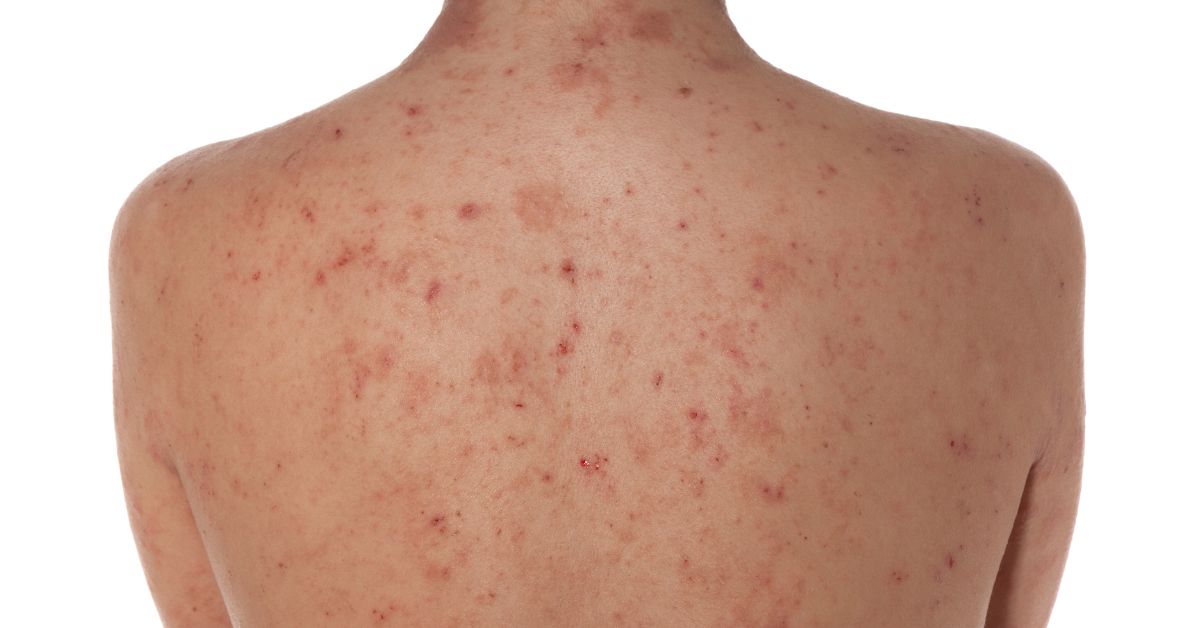 Topical Corticosteroids for Eczema Relief and Control BLDG Active