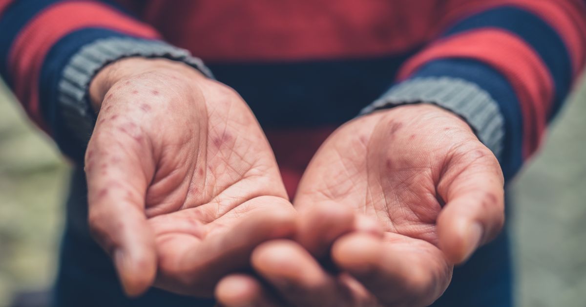 Understanding Hand Foot and Mouth Causes and Care BLDG Active