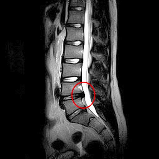 RM HERNIA DISCAL LUMBAR Blog de Fisioterapia