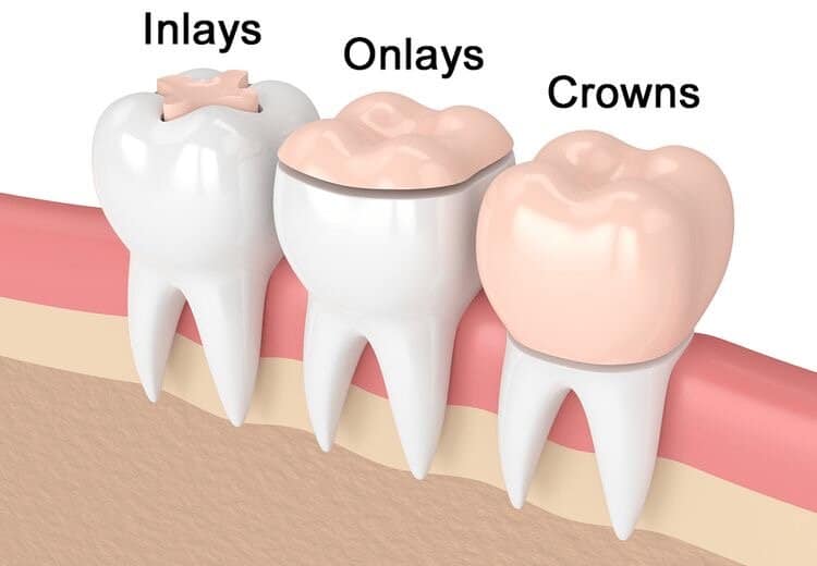 Dental Inlays & Onlays In Bloomfield, NJ Dental Care Bloomfield