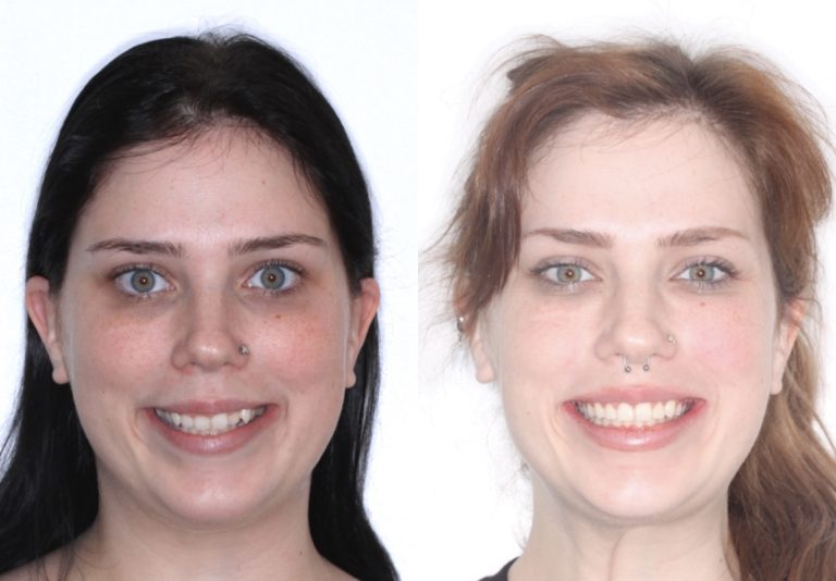 TAD NonSurgical Gummy Smile Correction Bloom Orthodontics Long