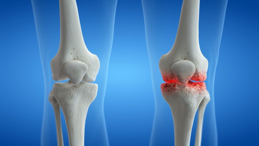 Understanding and Managing Knee Arthritis A Comprehensive Guide