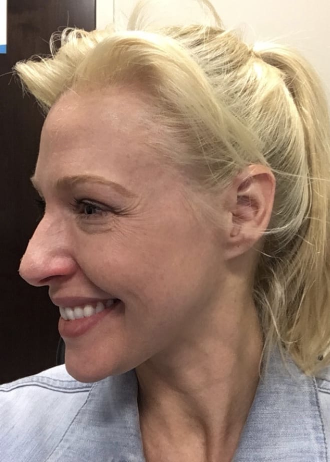 Pass the Botox, Please. Oh, and the Filler. bluegraygal
