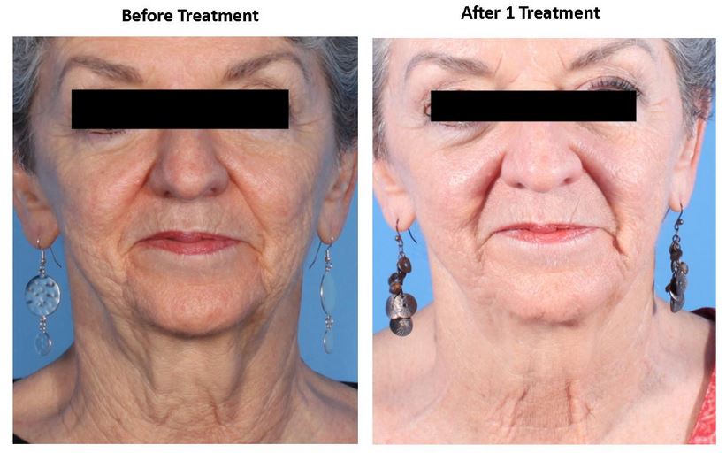 Dermapen Blue Medi Spa