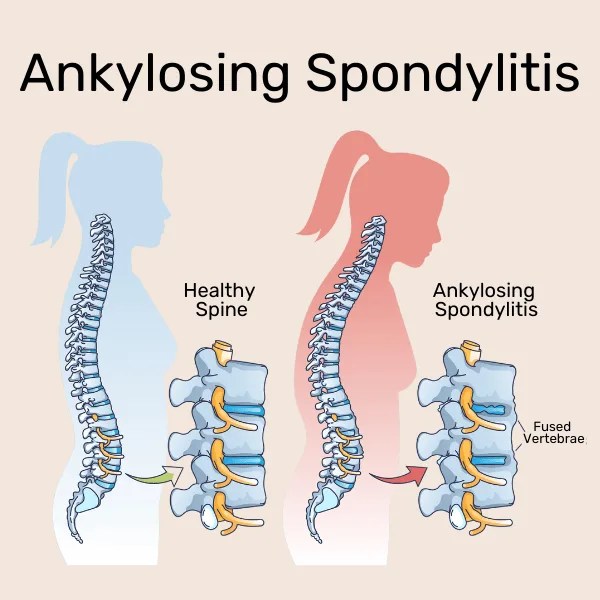 Role of Mitochondria in Arthritis