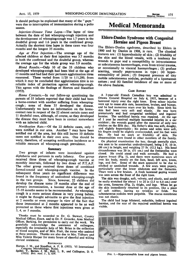 Ehlers—Danlos Syndrome with Congenital Herniae and Pigeon Breast The BMJ