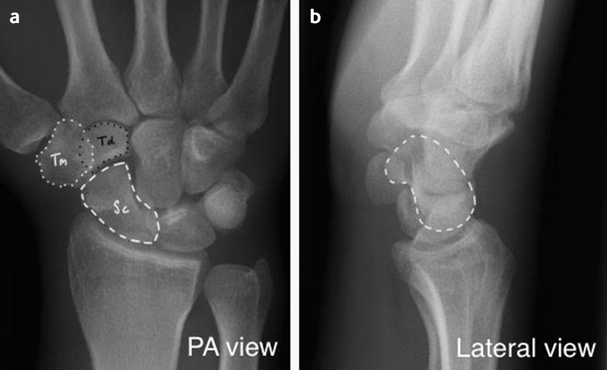 Fractures of the scaphoid The BMJ