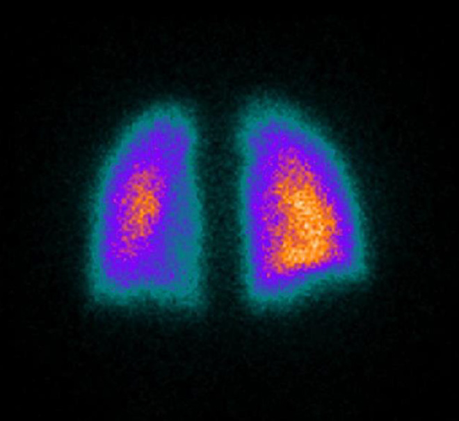 Lung Scan British Nuclear Medicine Society