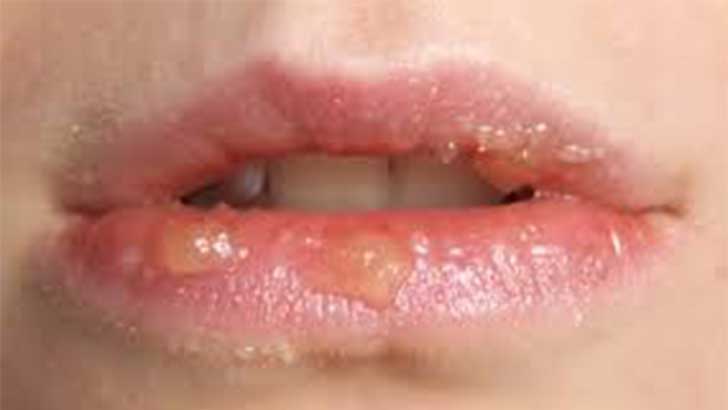 10 Steps of Rash on Lips Treatment Causes & Symptoms Body Allergy