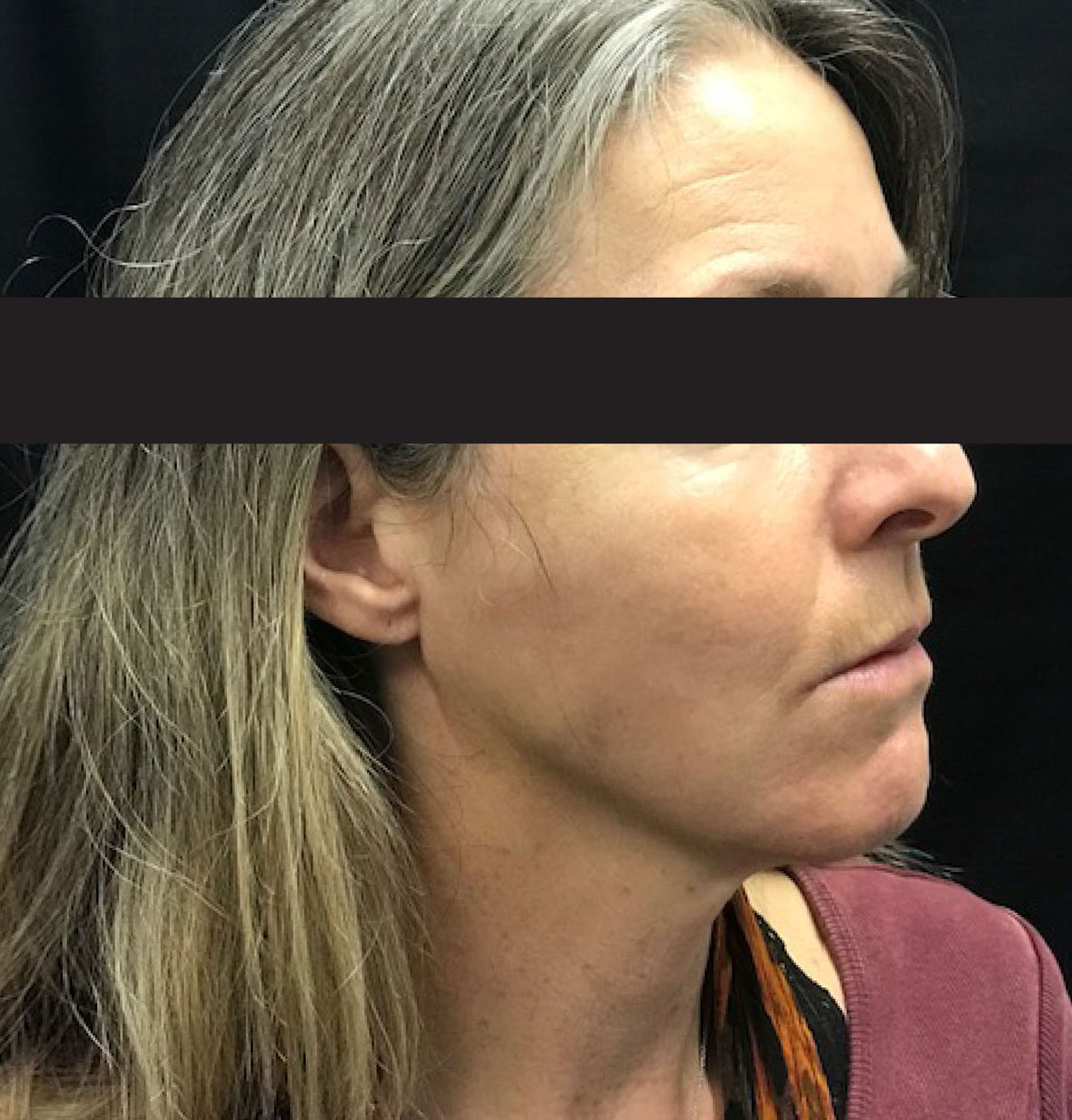 Thread Lift Nonsurgical Face & Neck Lift Santa Cruz