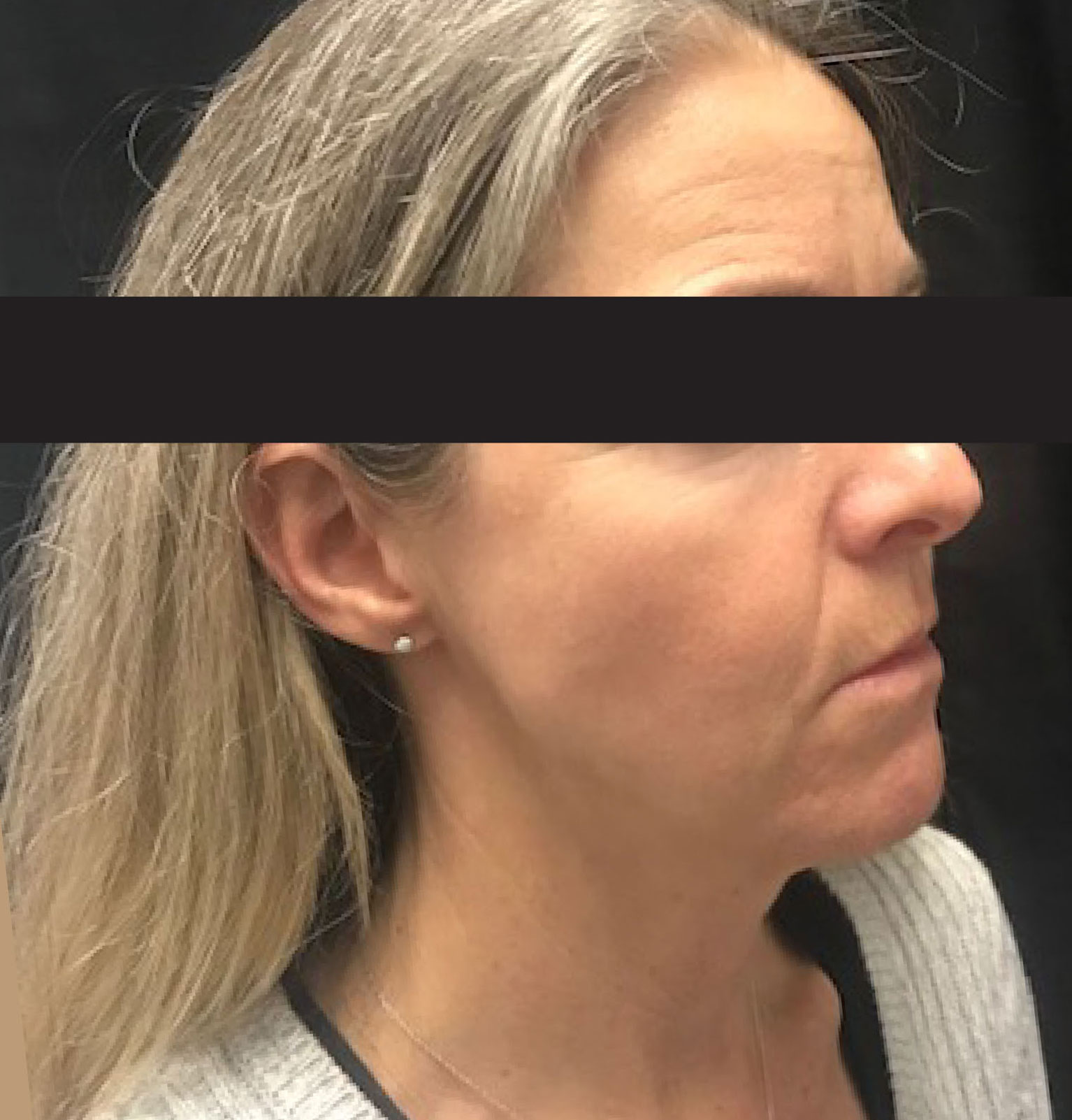 Thread Lift Nonsurgical Face & Neck Lift Santa Cruz