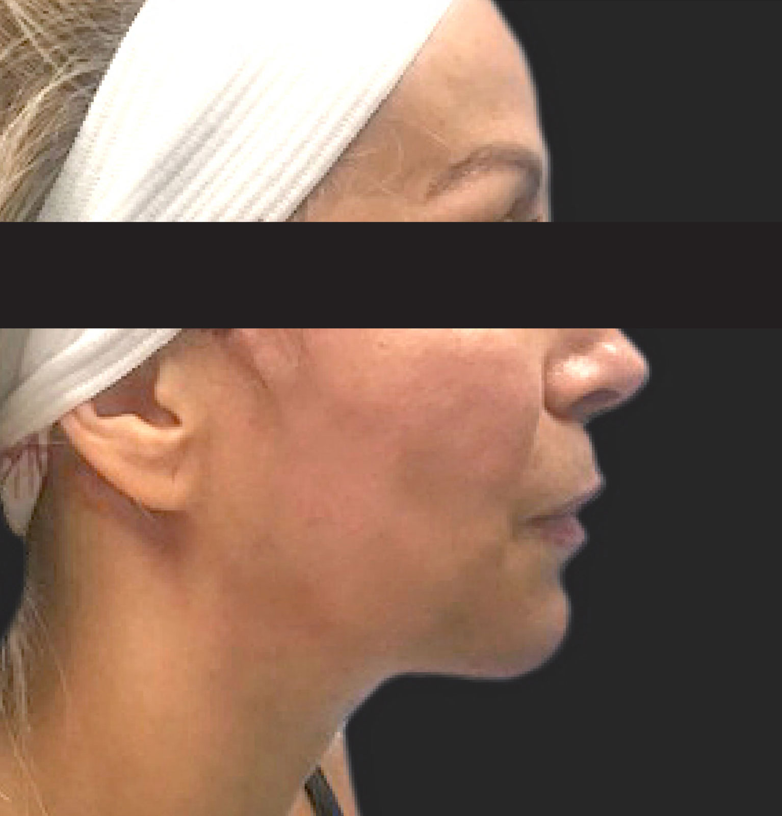 Thread Lift Nonsurgical Face & Neck Lift Santa Cruz