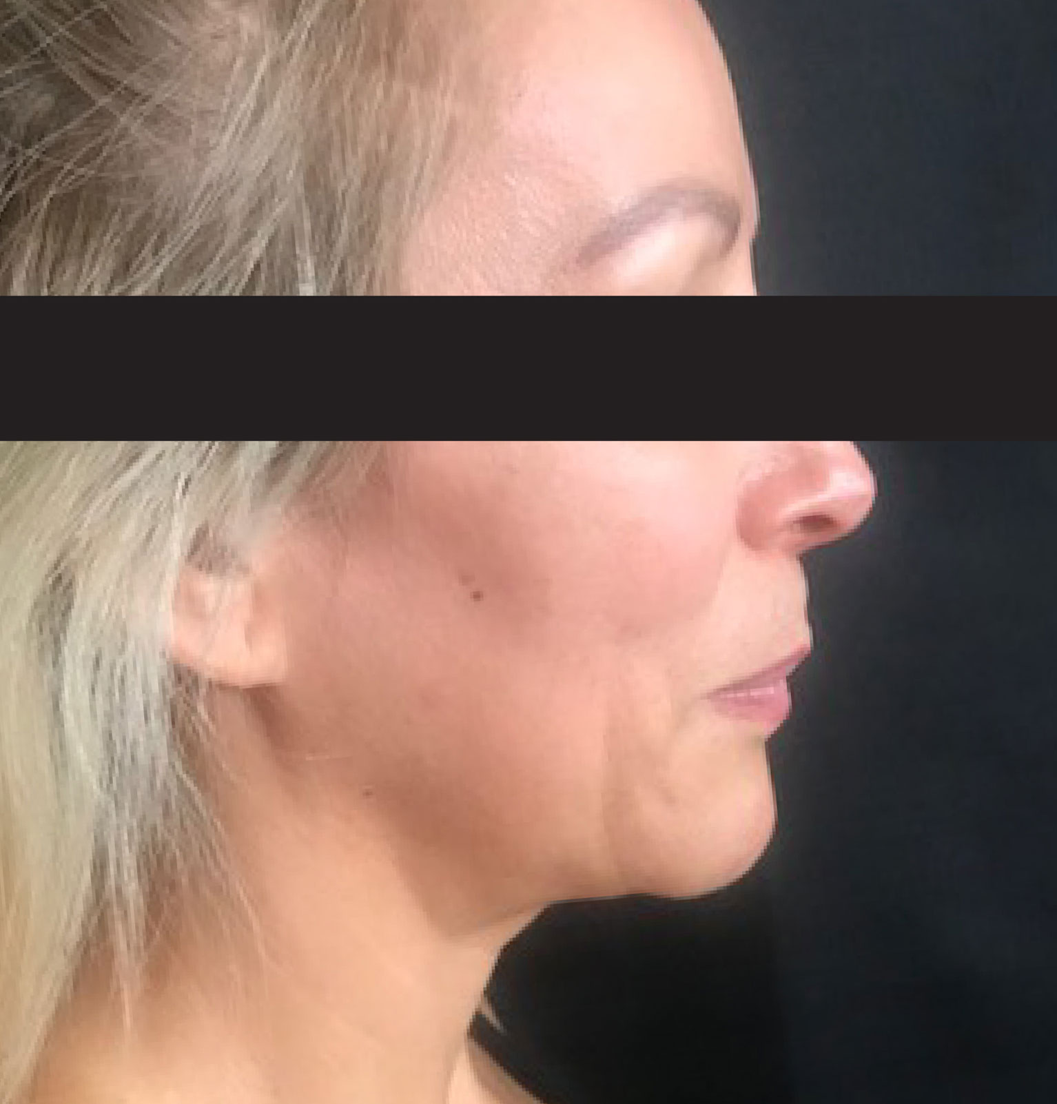 Thread Lift Nonsurgical Face & Neck Lift Santa Cruz