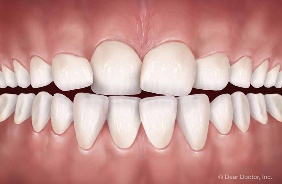 Early Treatment Florence SC Bonds & Patton Orthodontics