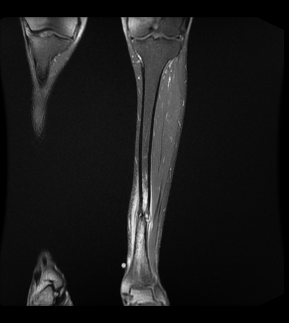 Tibial Stress Fractures The Bone School