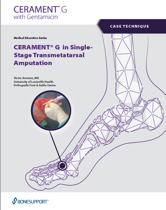 CERAMENT G in SingleStage Transmetatarsal Amputation Victor Anciano