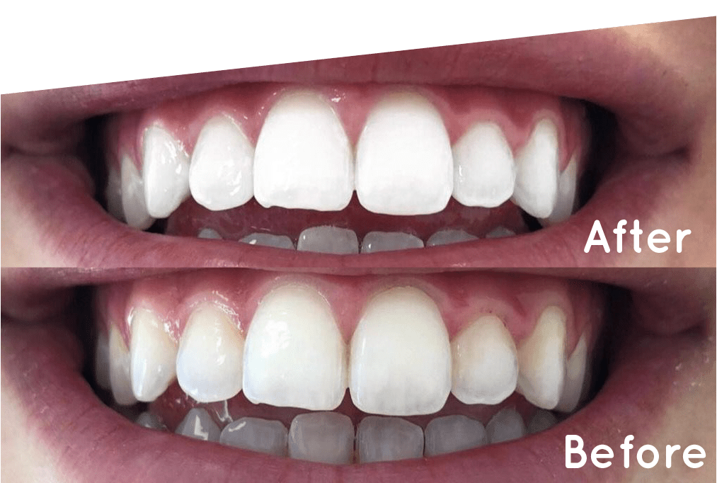 Laser Teeth Whitening 2023 Procedure, Costs, Reviews, 45 OFF