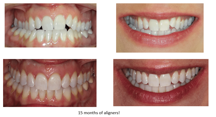 FAQ Invisalign