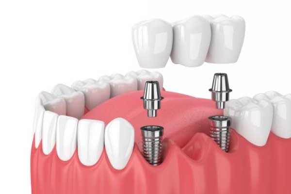 Gรผney Kore implantlarฤฑna damping soruลturmasฤฑ Borsatek