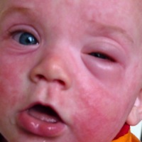 Voedselallergie Bij Zuigelingen - Borstvoeding