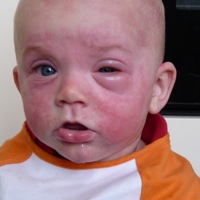 Voedselallergie Bij Zuigelingen - Borstvoeding