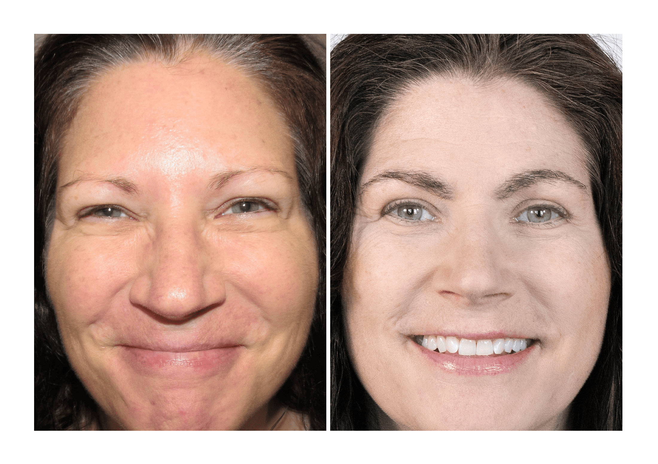 Hair Transplant Before/After Results for Women Bosley Hair Transplant