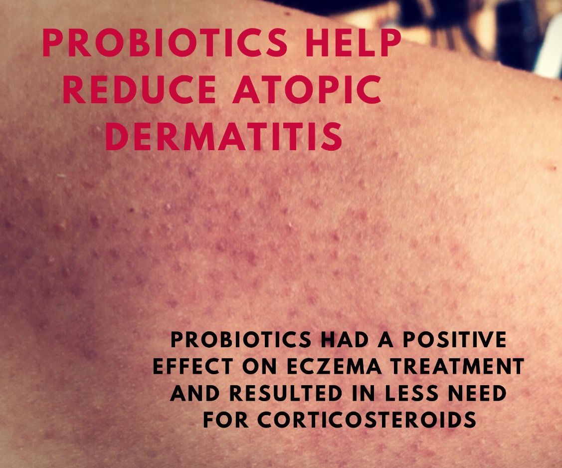 PROBIOTICS HELP REDUCE ATOPIC DERMATITIS Botanica Media