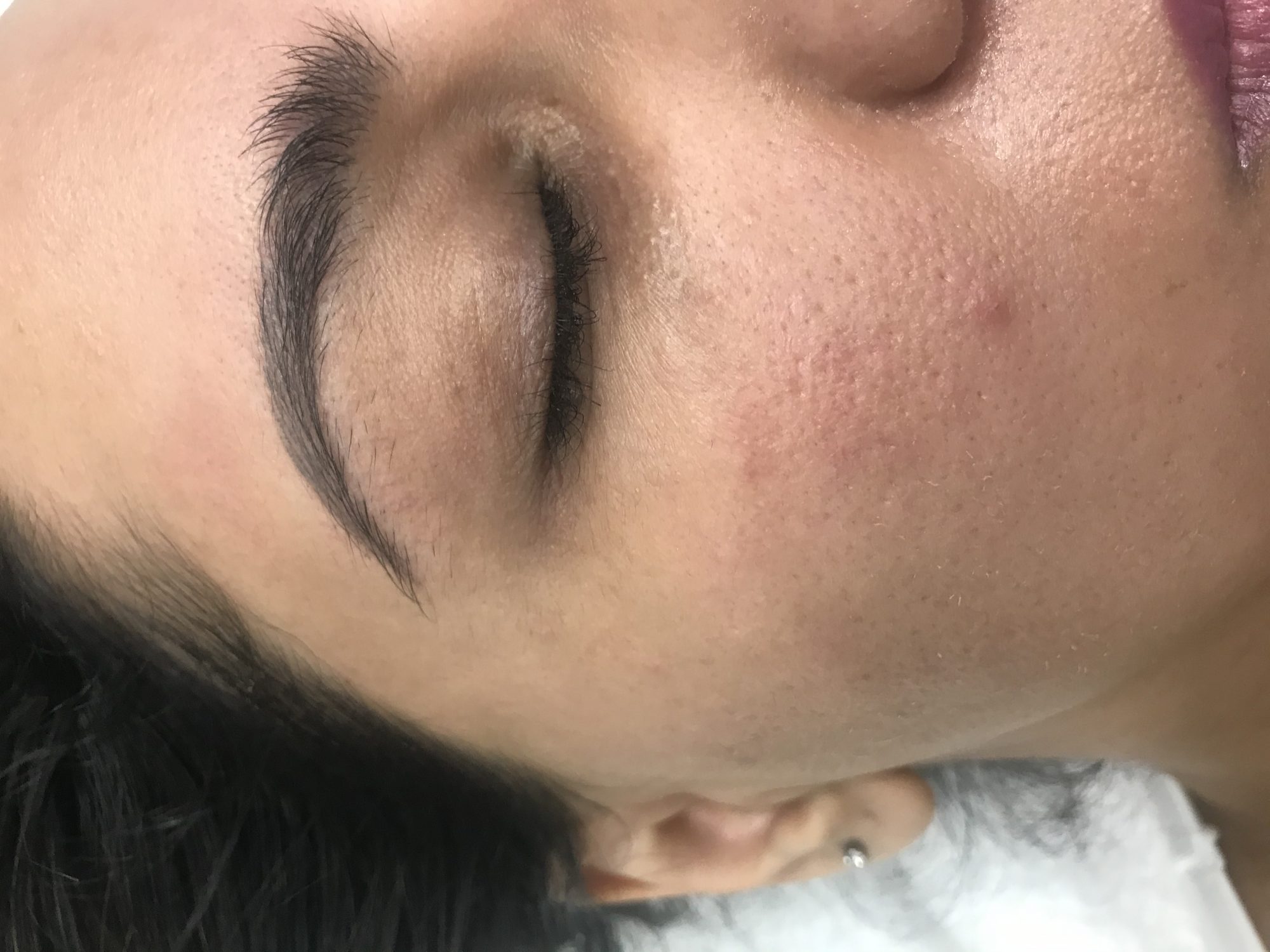 Dark circles improve your circulation under eyes Carboxy helps a lot
