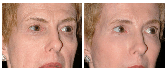 Tissue Fillers Pretoria Tissue Filler Treatment Garden Route